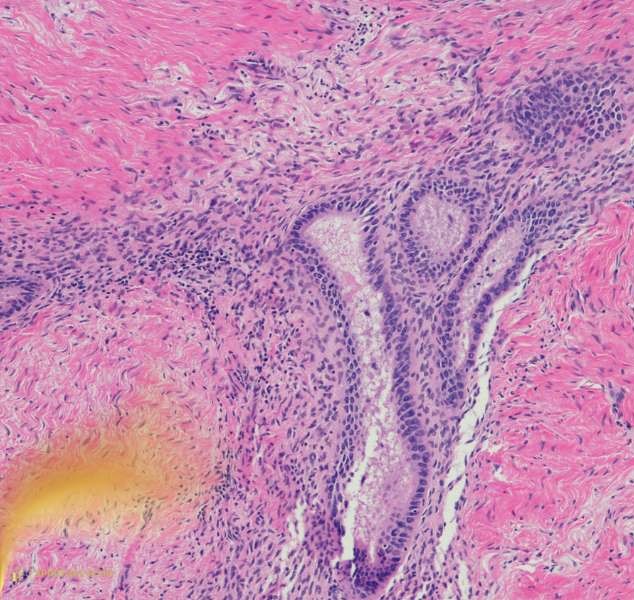 Energetic cause of endometriosis
