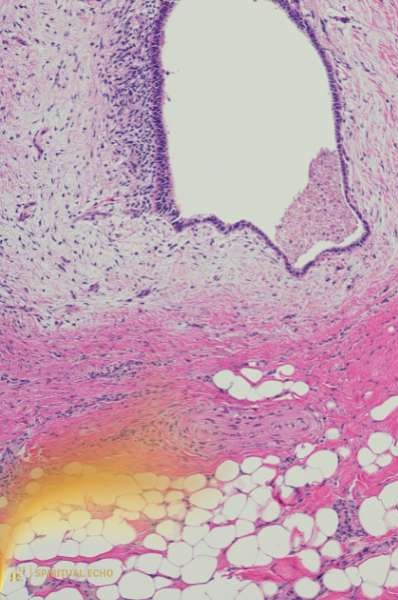 The emotional cause of endometriosis