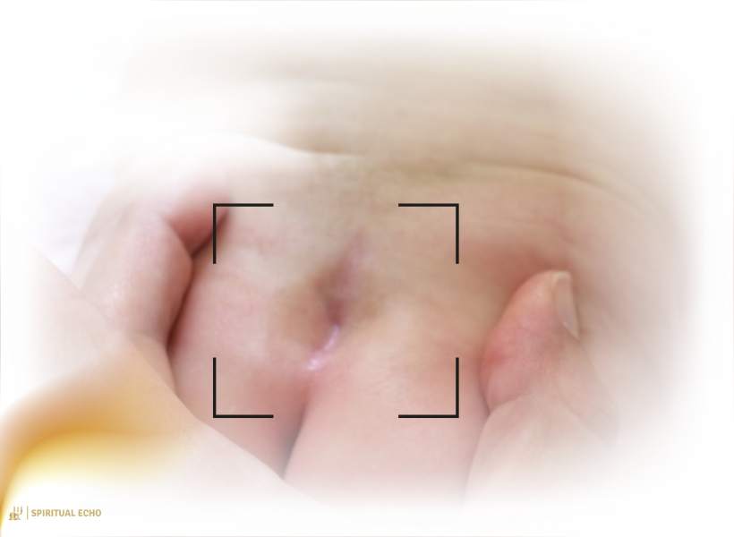 What Is A Sacral Dimple_ (Medical And Physical Overview)